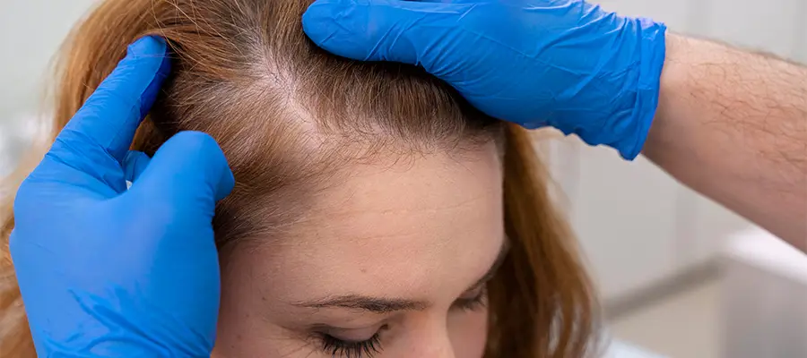 Homeopathic Treatment for Hair Loss