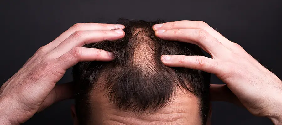 hair loss p img1